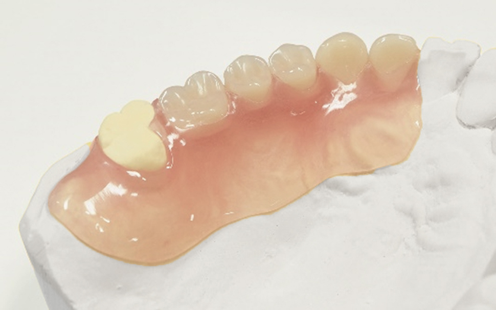 ノンクラスプデンチャー