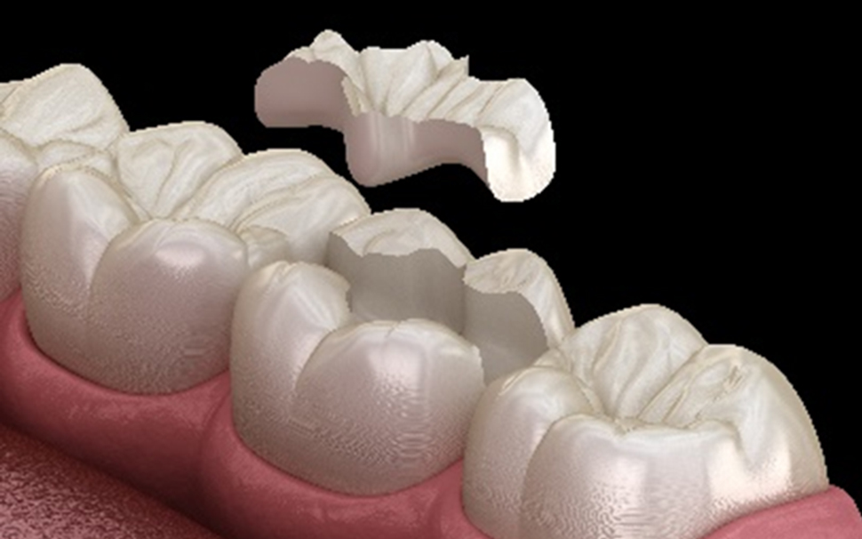 つめもの（インレー）