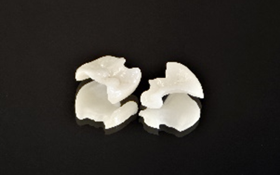 つめもの（インレー）