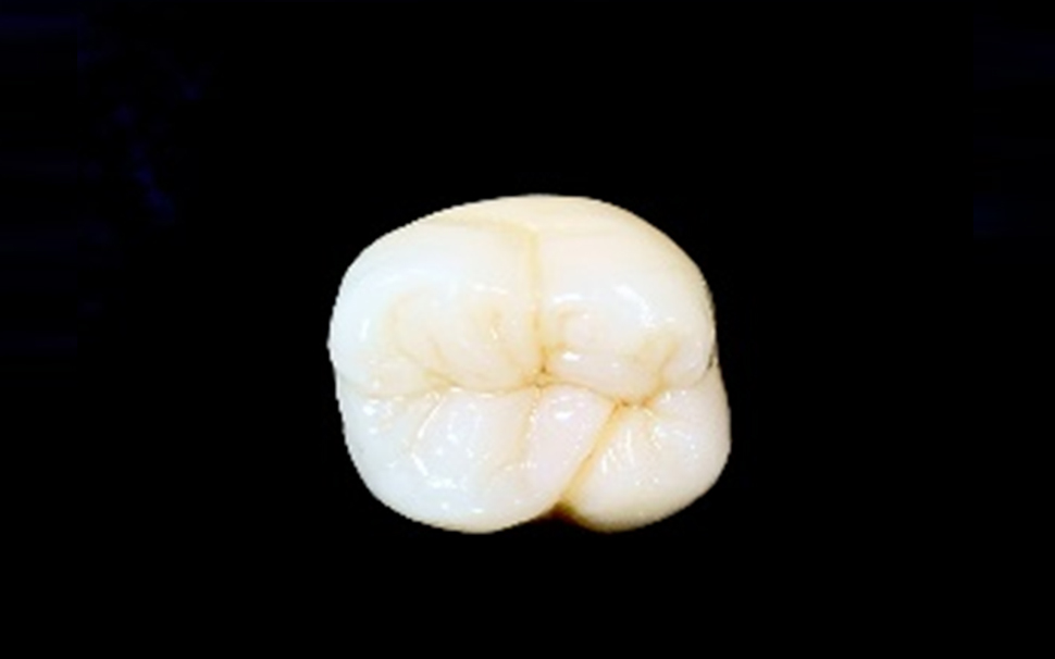 かぶせもの（クラウン）