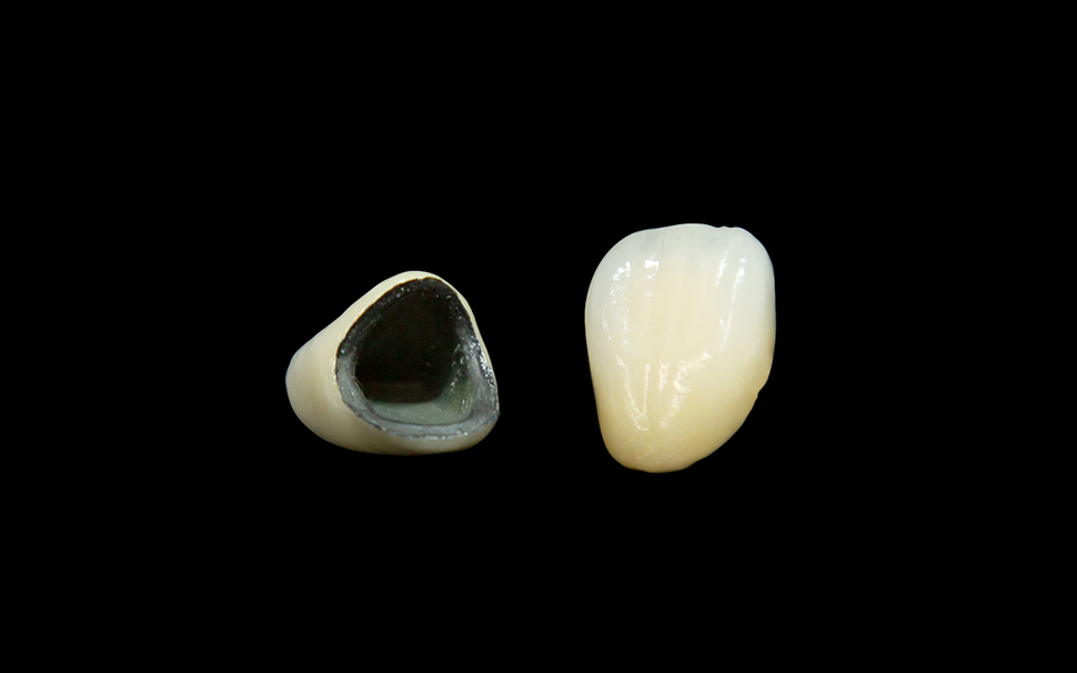 かぶせもの（クラウン）