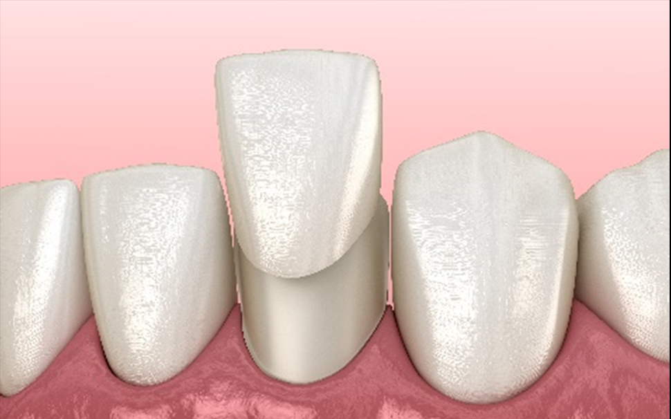 ラミネートベニア