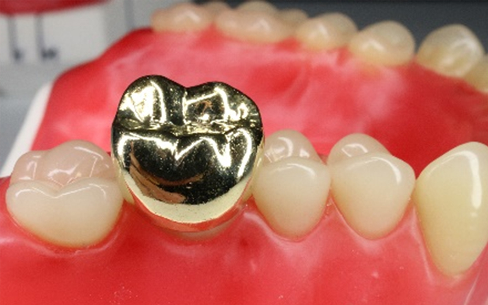 かぶせもの（クラウン）