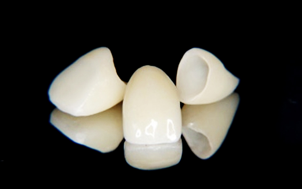 かぶせもの（クラウン）